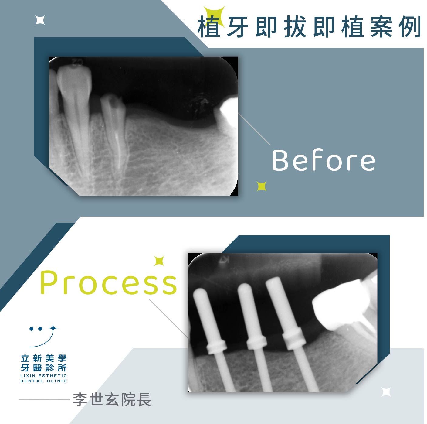 植牙案例_即拔即植(三)