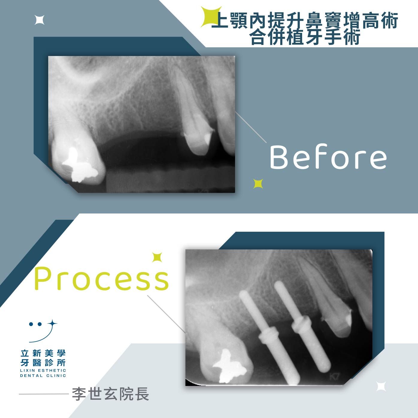 植牙案例_鼻竇增高植牙手術