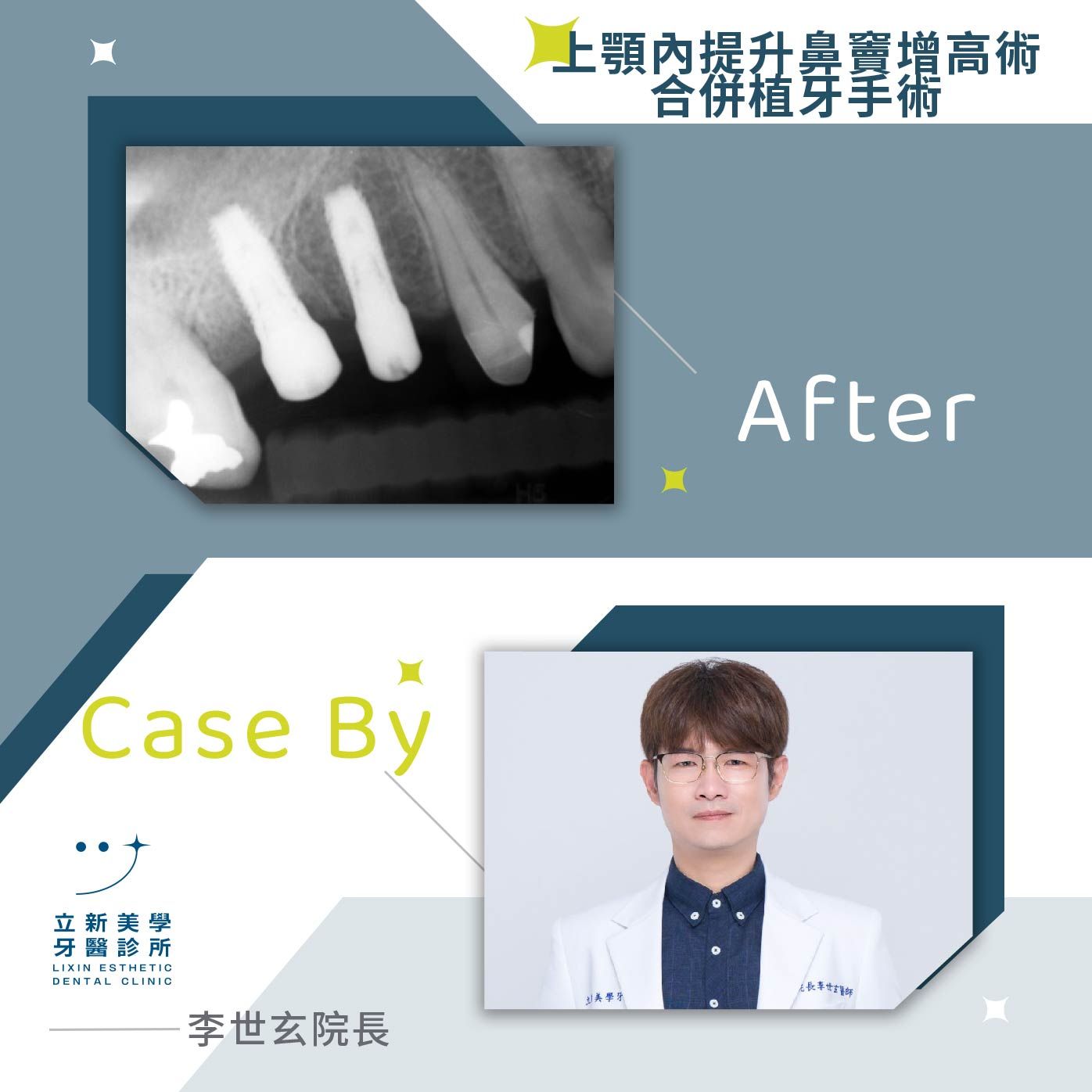 植牙案例_鼻竇增高植牙手術