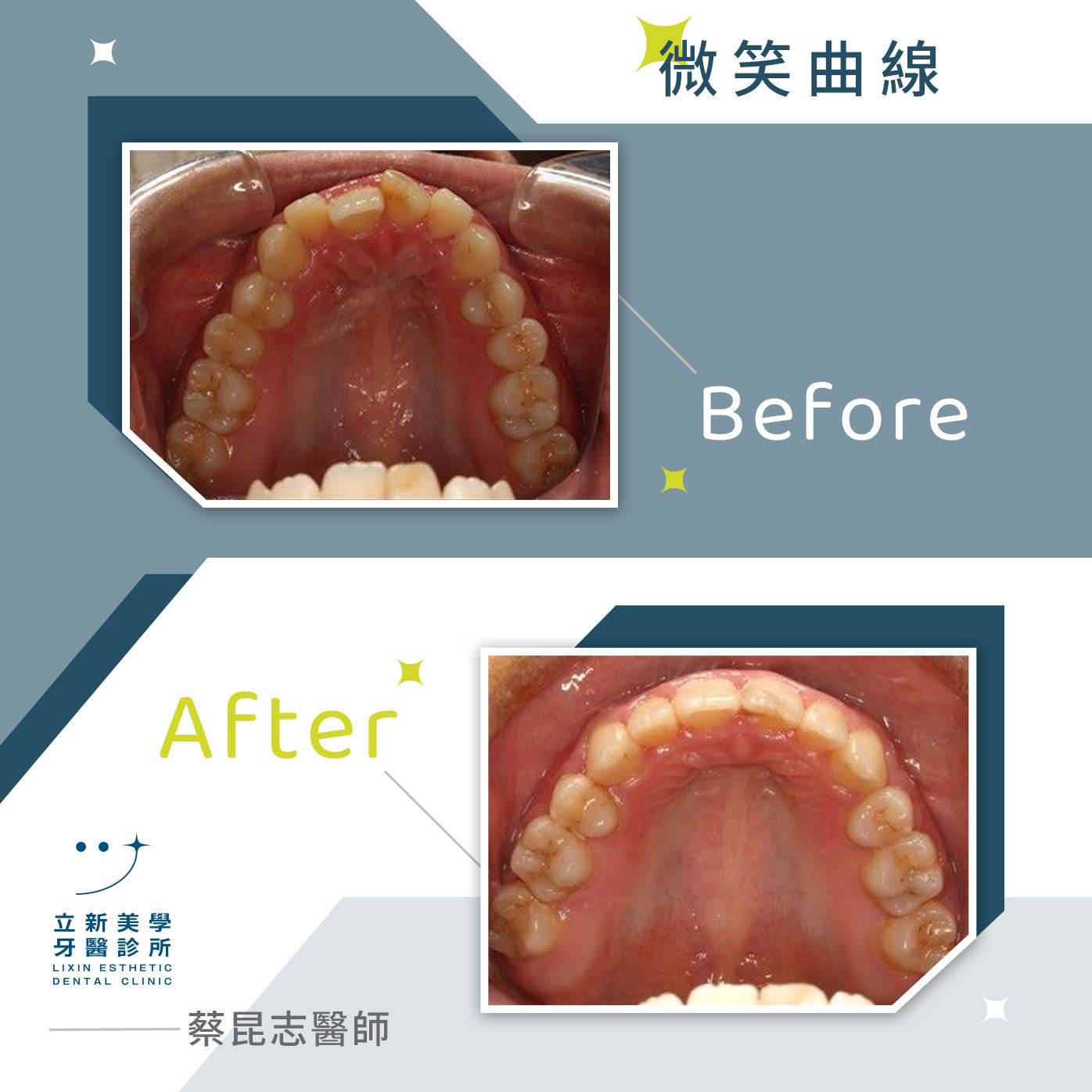 微笑曲線 FT.蔡昆志醫師