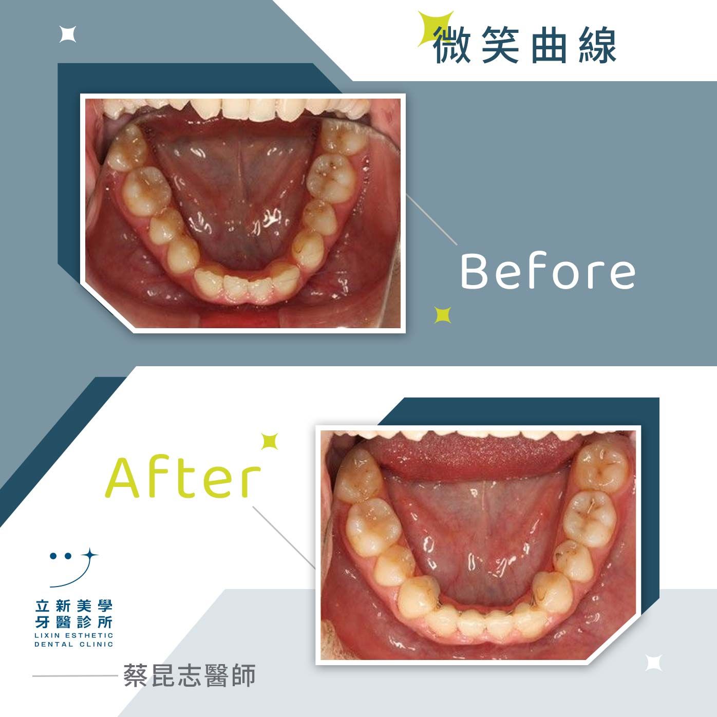 微笑曲線 FT.蔡昆志醫師