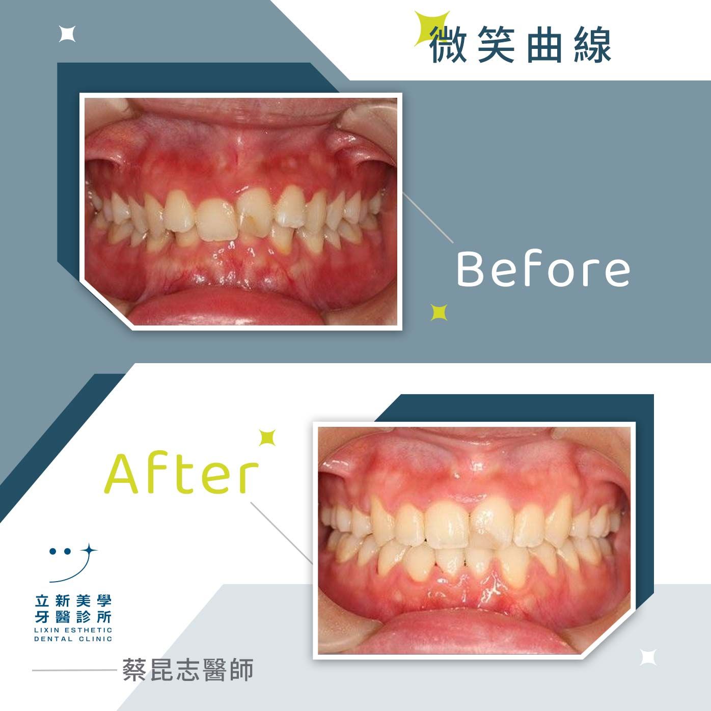 微笑曲線 FT.蔡昆志醫師