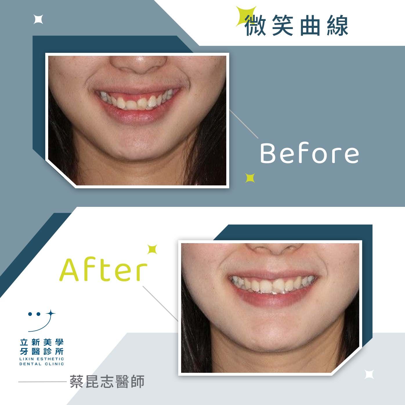 微笑曲線 FT.蔡昆志醫師