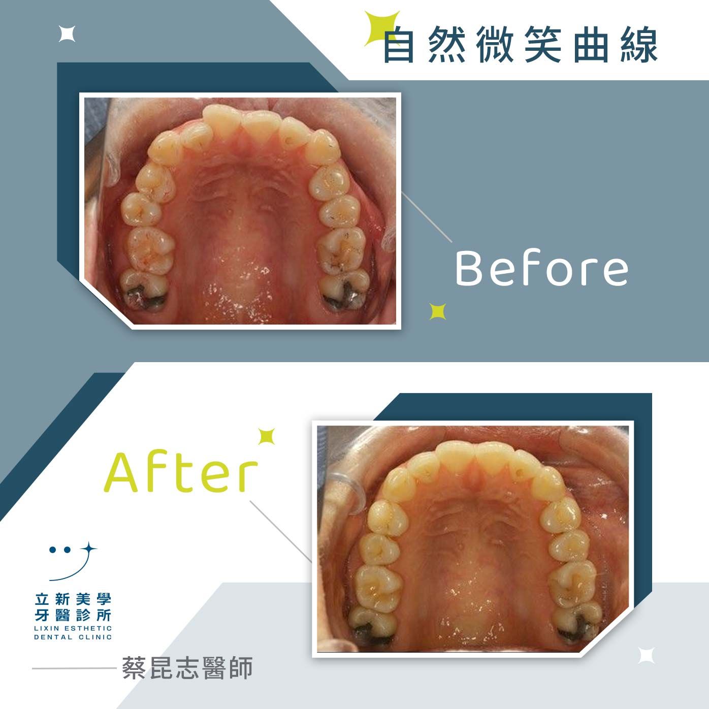 自然微笑曲線 FT.蔡昆志醫師