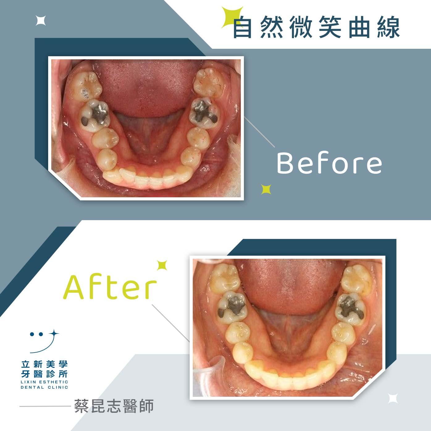 自然微笑曲線 FT.蔡昆志醫師