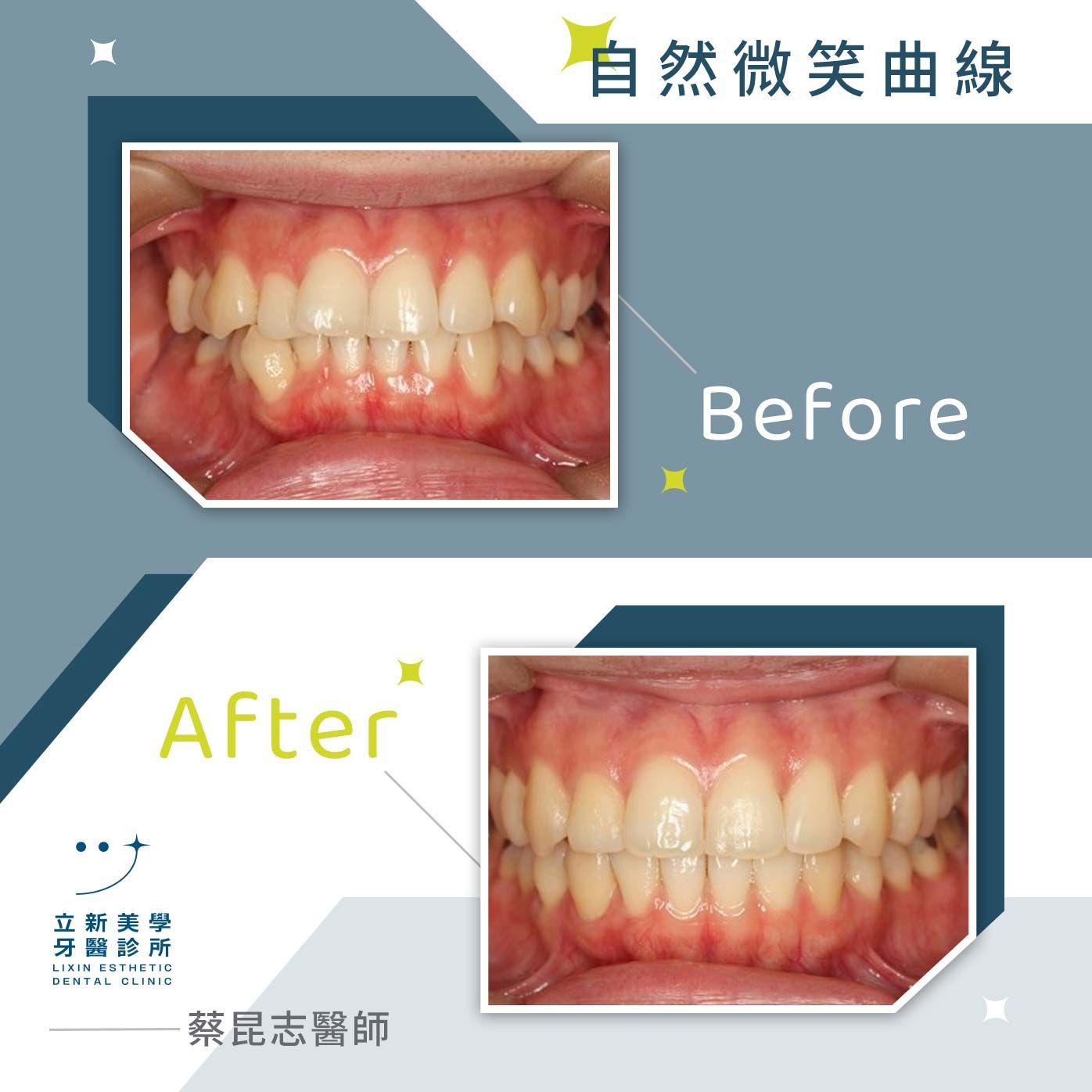 自然微笑曲線 FT.蔡昆志醫師
