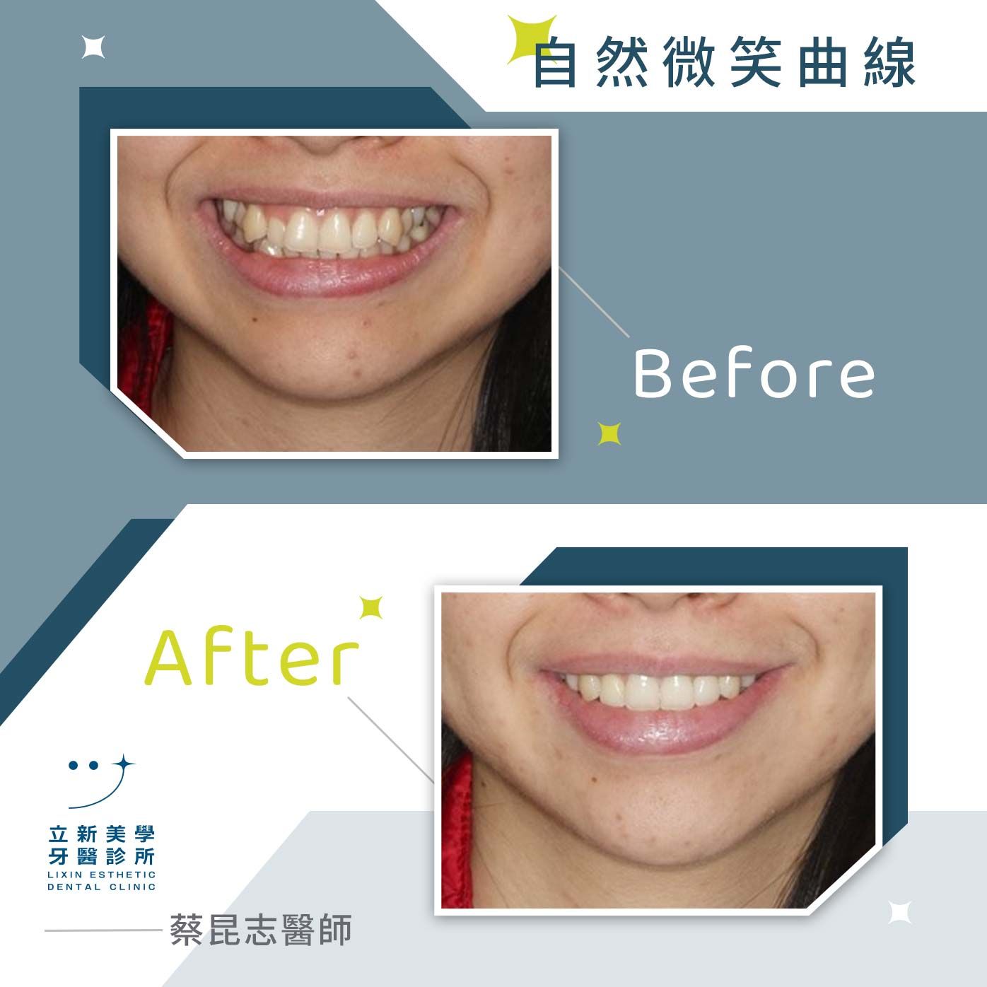 自然微笑曲線 FT.蔡昆志醫師