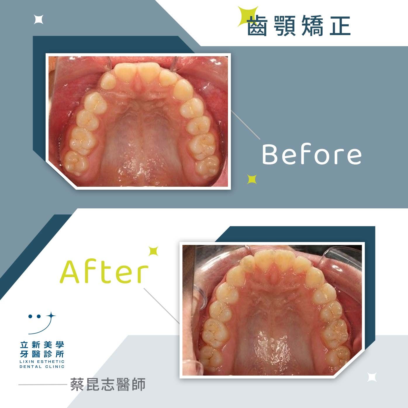 齒顎矯正 FT.蔡昆志醫師