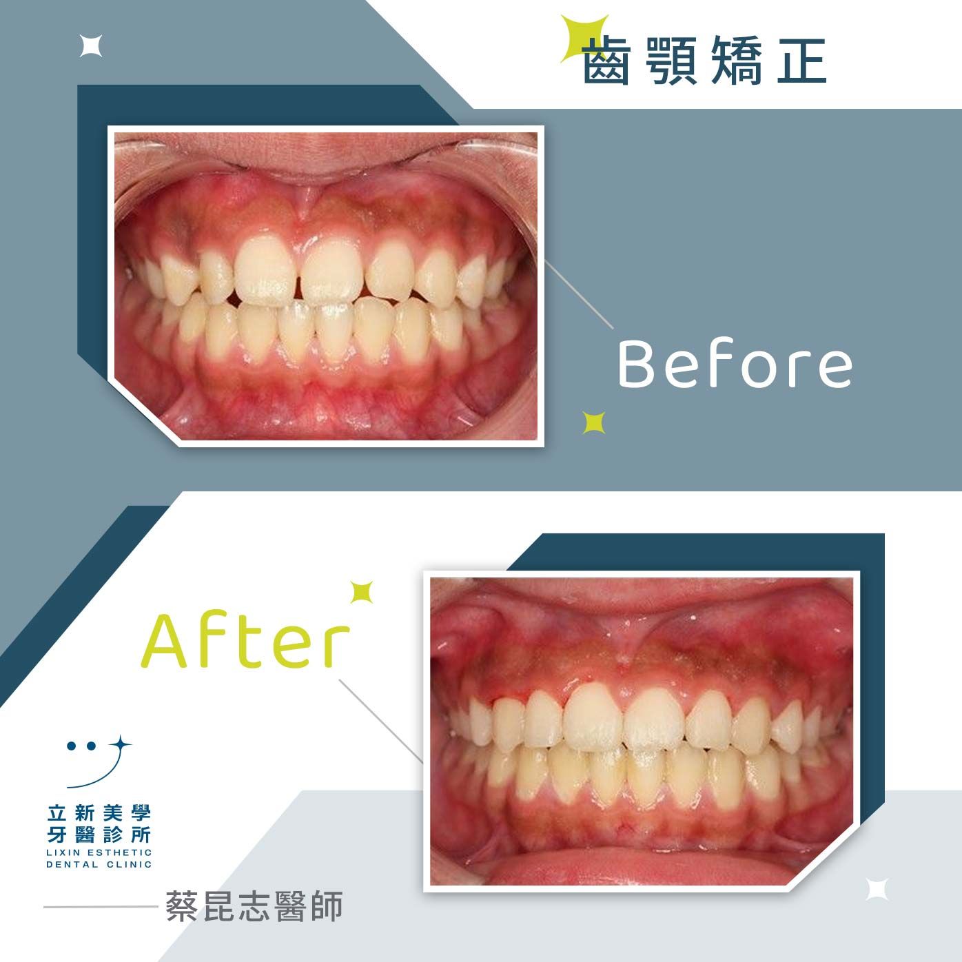 齒顎矯正 FT.蔡昆志醫師