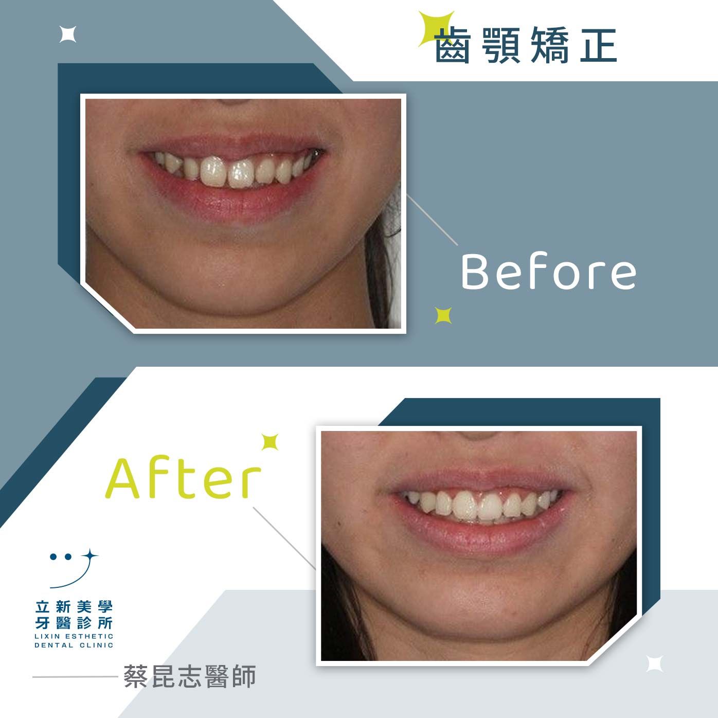齒顎矯正 FT.蔡昆志醫師
