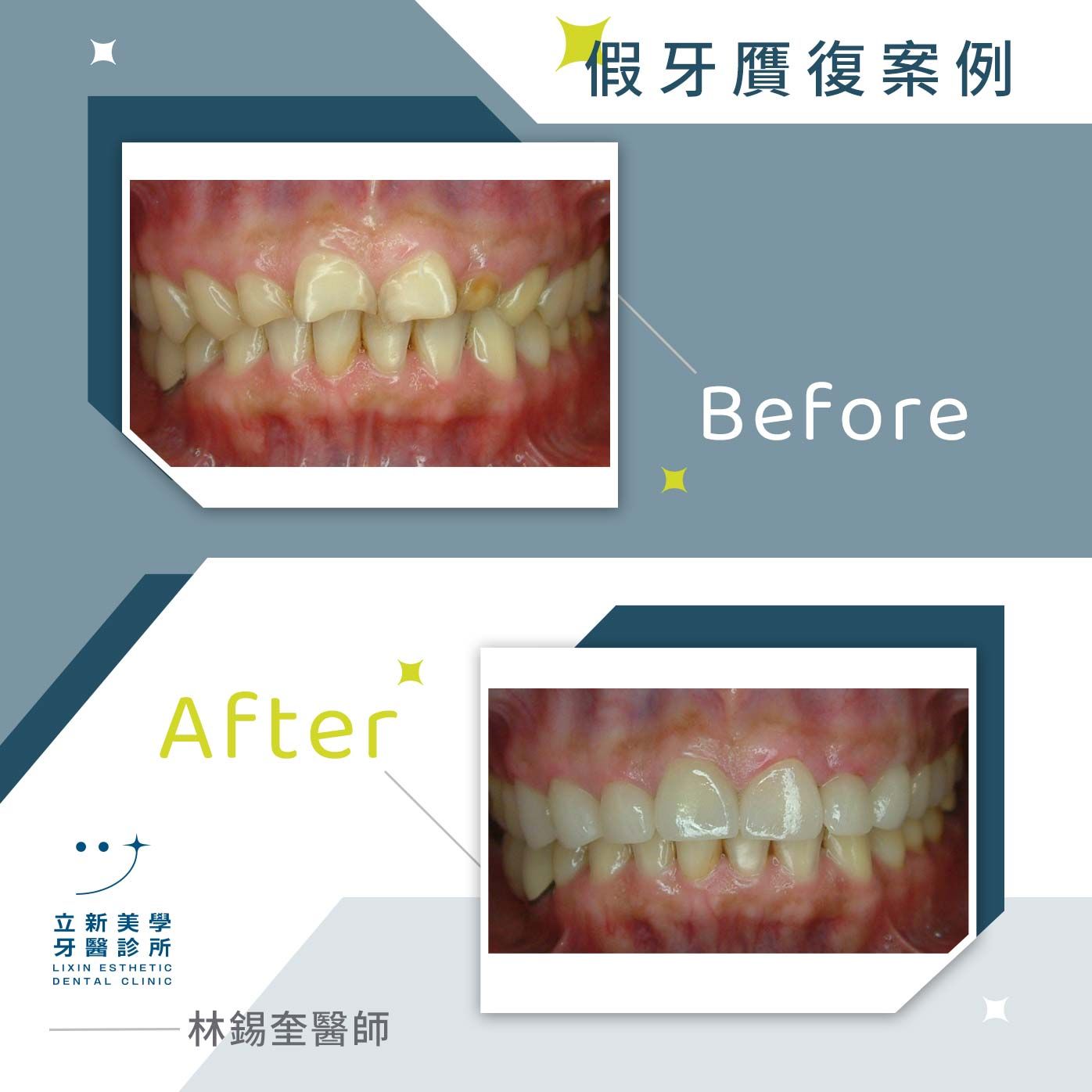 假牙贋復案例 FT.林錫奎醫師