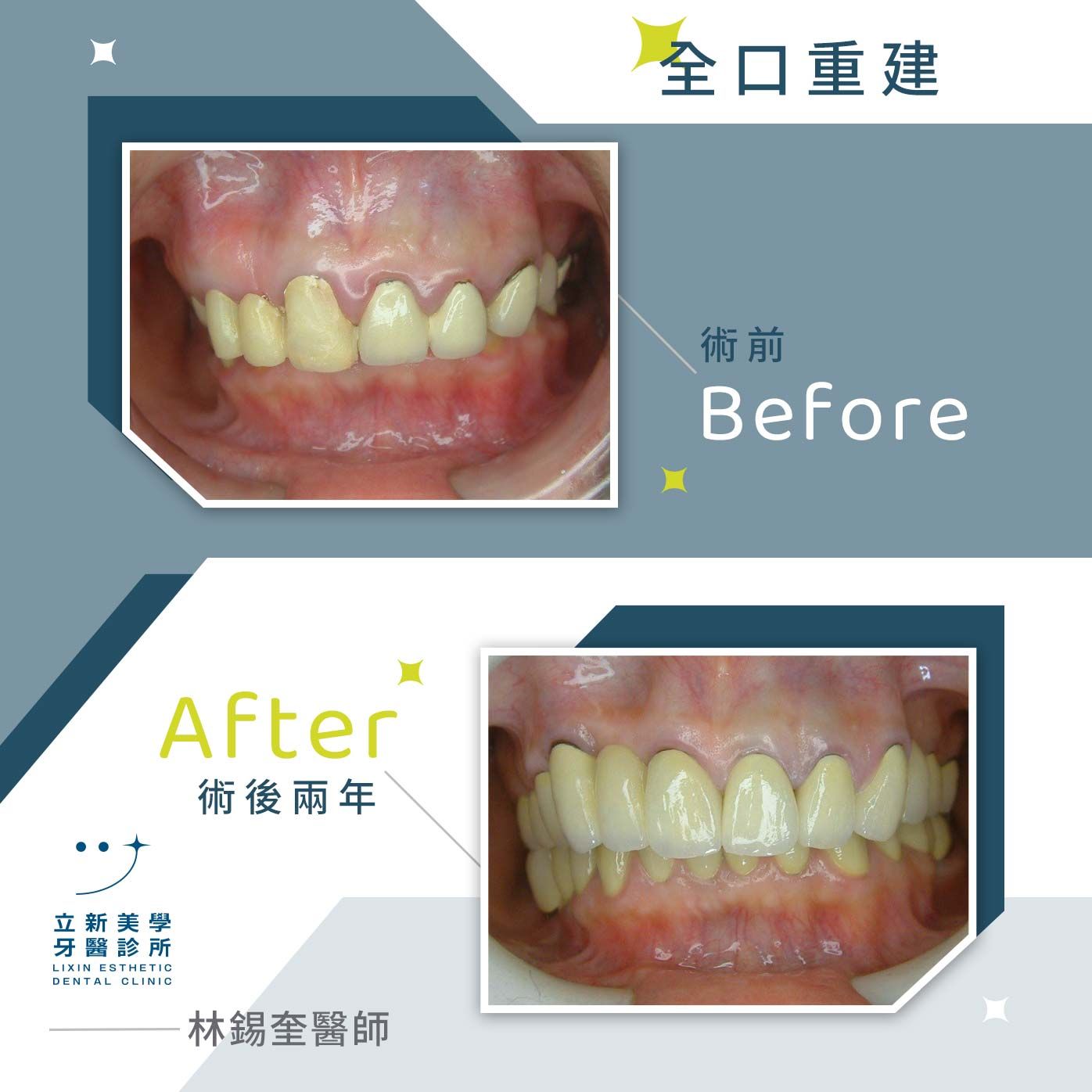 全口重建 FT.林錫奎醫師
