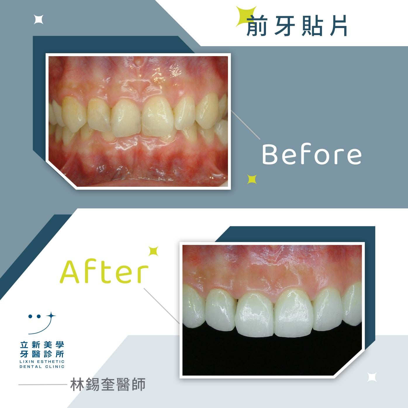 前牙貼片 ft.林錫奎醫師