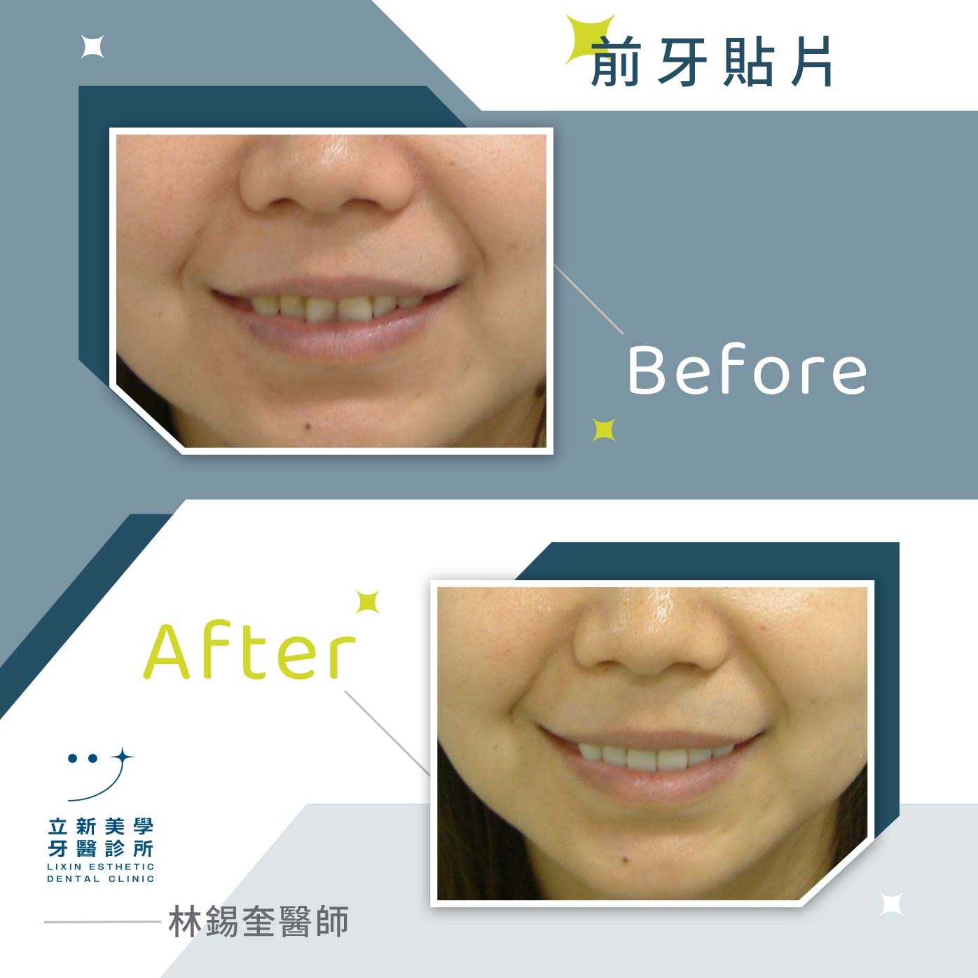 前牙貼片 ft.林錫奎醫師